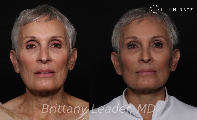 Face & Neck Lift Before & After Image