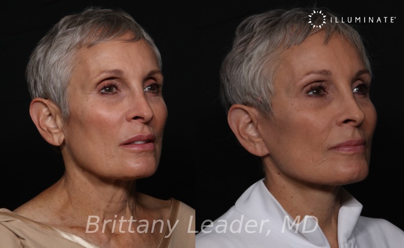 Face & Neck Lift Before & After Image