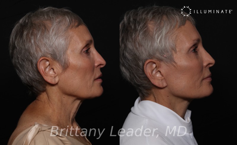 Face & Neck Lift Before & After Image