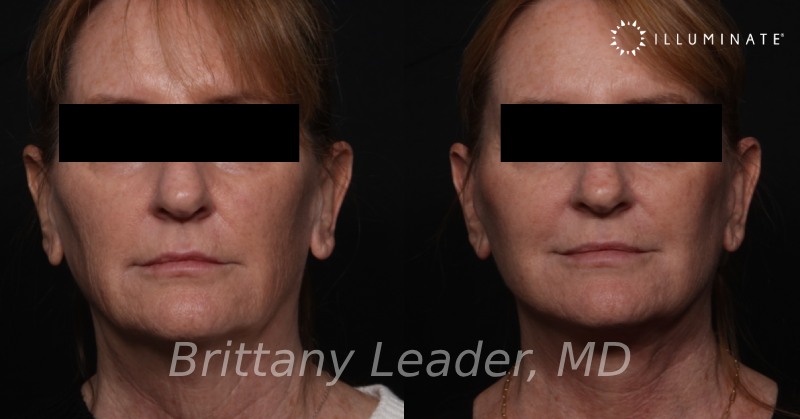 Face & Neck Lift Before & After Image