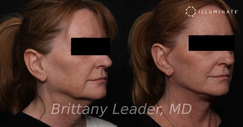 Face & Neck Lift Before & After Image