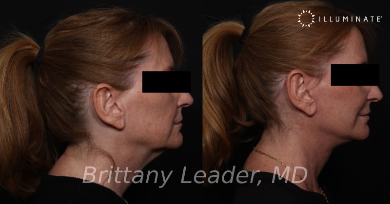 Face & Neck Lift Before & After Image