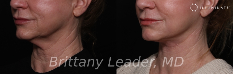 Face & Neck Lift Before & After Image