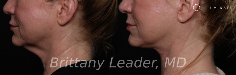 Face & Neck Lift Before & After Image