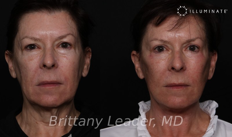 Face & Neck Lift Before & After Image