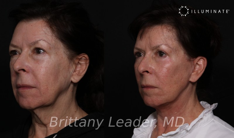 Face & Neck Lift Before & After Image