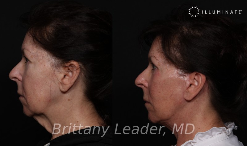 Face & Neck Lift Before & After Image