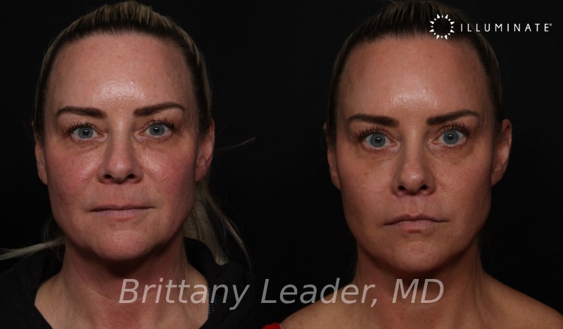 Face & Neck Lift Before & After Image