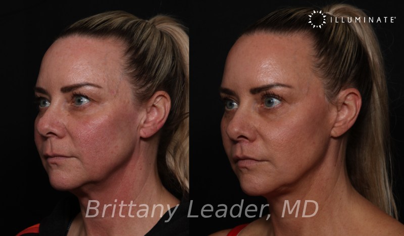 Face & Neck Lift Before & After Image