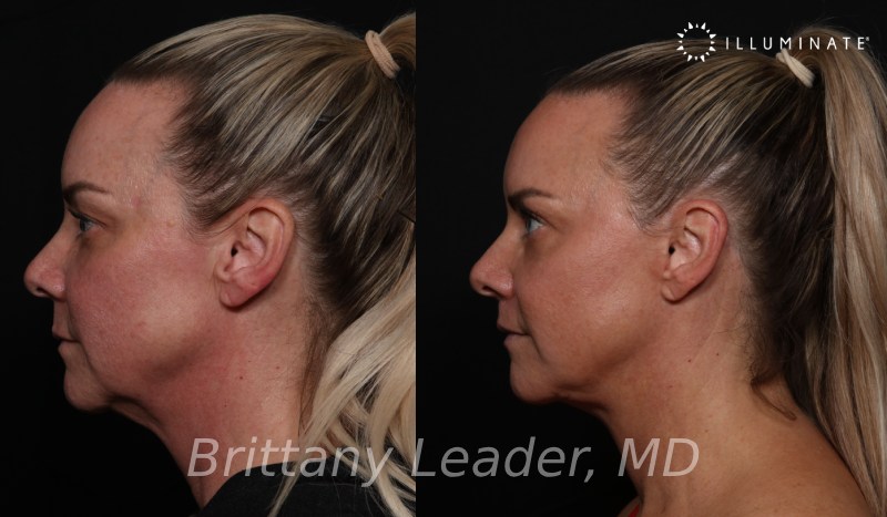 Face & Neck Lift Before & After Image