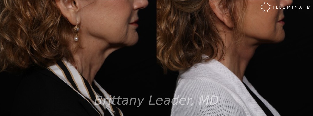 Face & Neck Lift Before & After Image