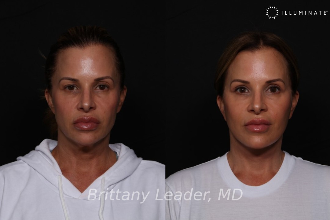 Face & Neck Lift Before & After Image