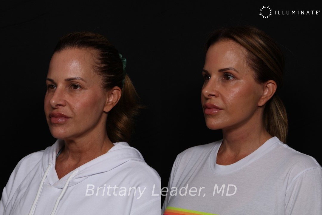 Face & Neck Lift Before & After Image