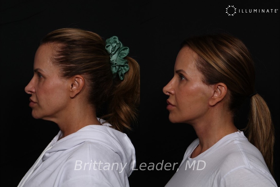 Face & Neck Lift Before & After Image