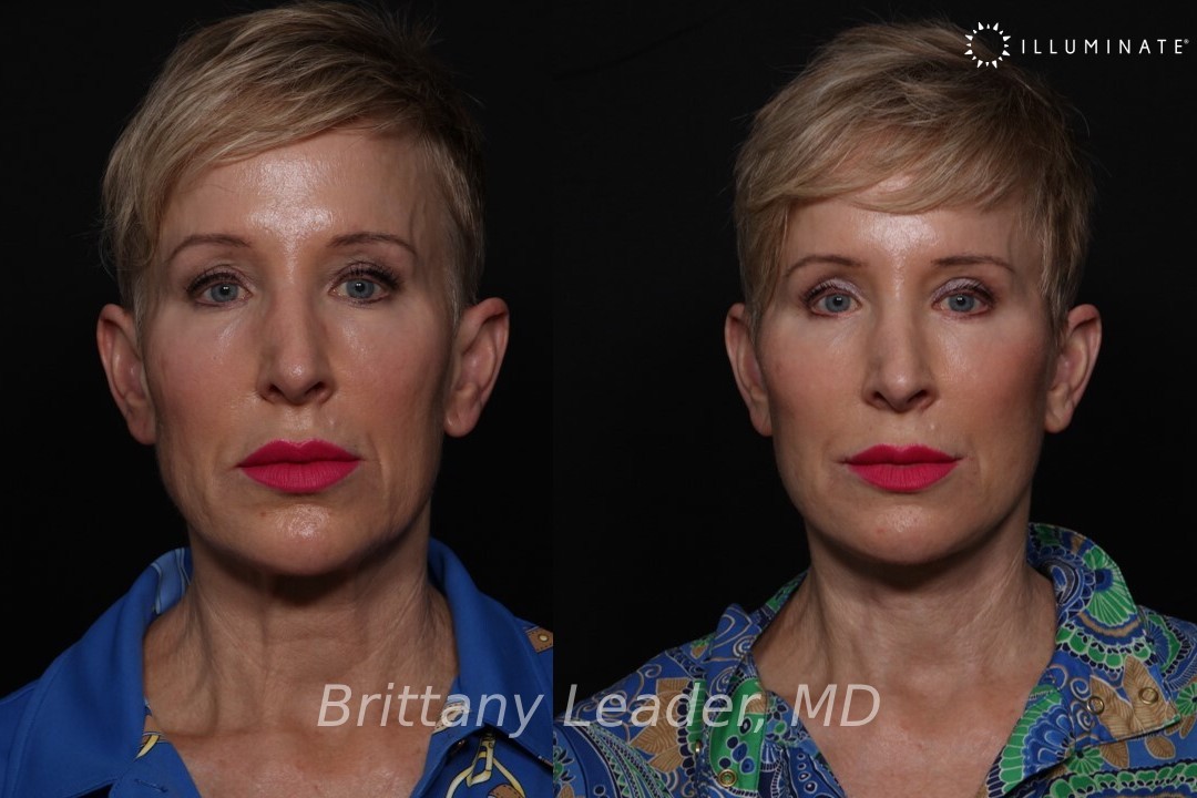 Face & Neck Lift Before & After Image