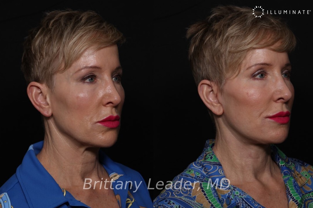 Face & Neck Lift Before & After Image