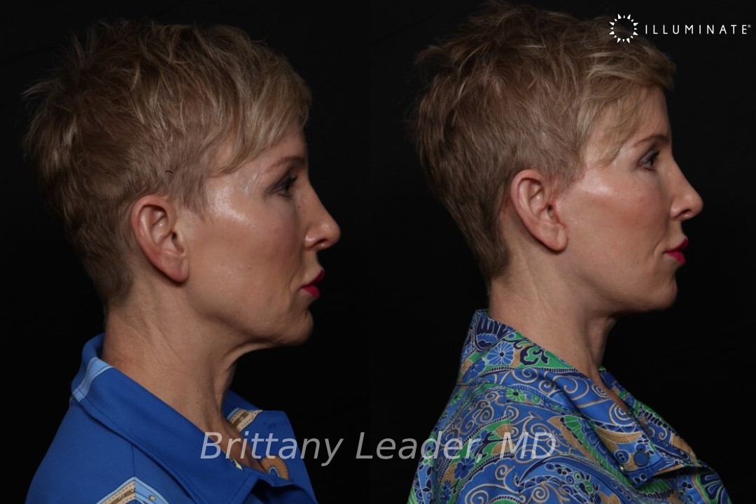 Face & Neck Lift Before & After Image