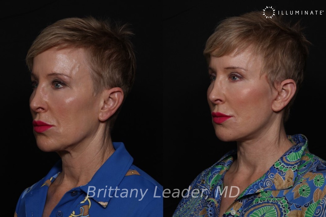 Face & Neck Lift Before & After Image