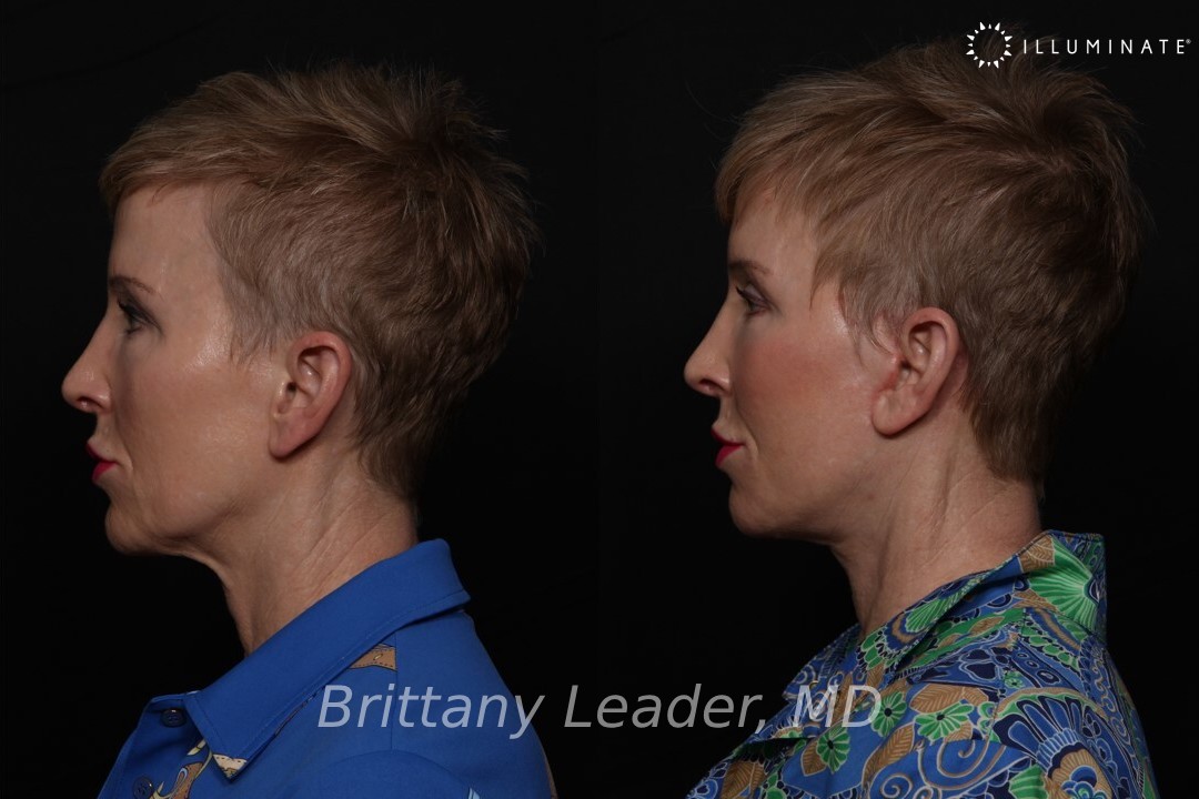 Face & Neck Lift Before & After Image