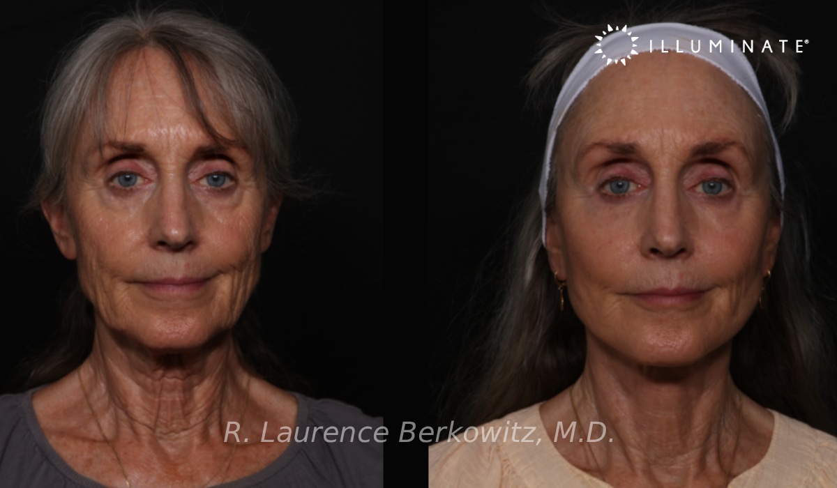 Face & Neck Lift Before & After Image