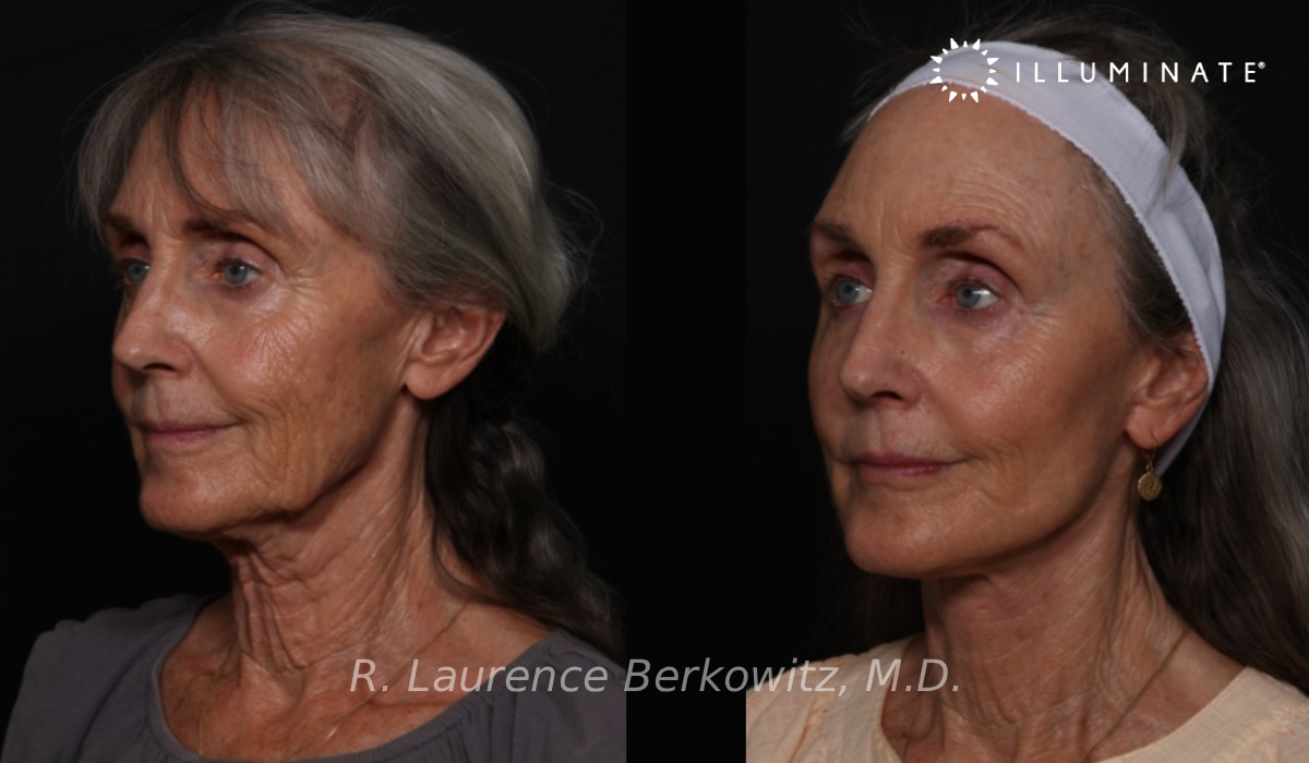 Face & Neck Lift Before & After Image