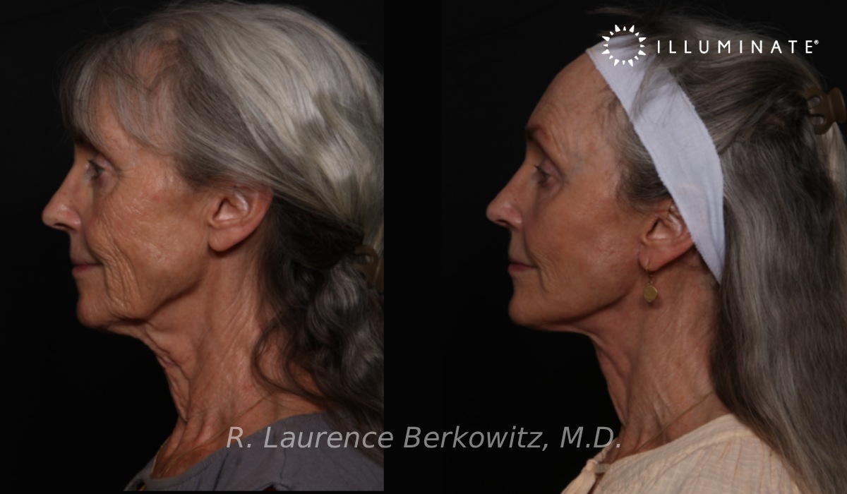Face & Neck Lift Before & After Image