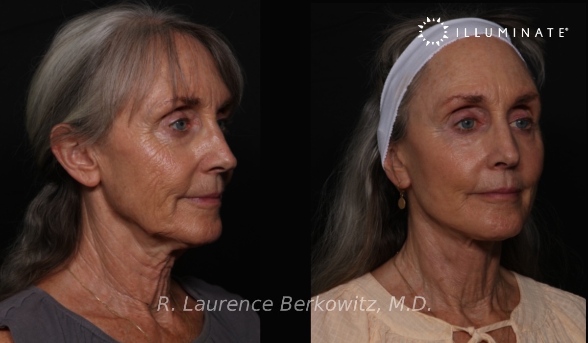 Face & Neck Lift Before & After Image
