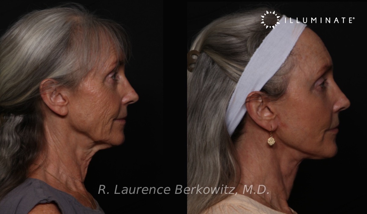 Face & Neck Lift Before & After Image