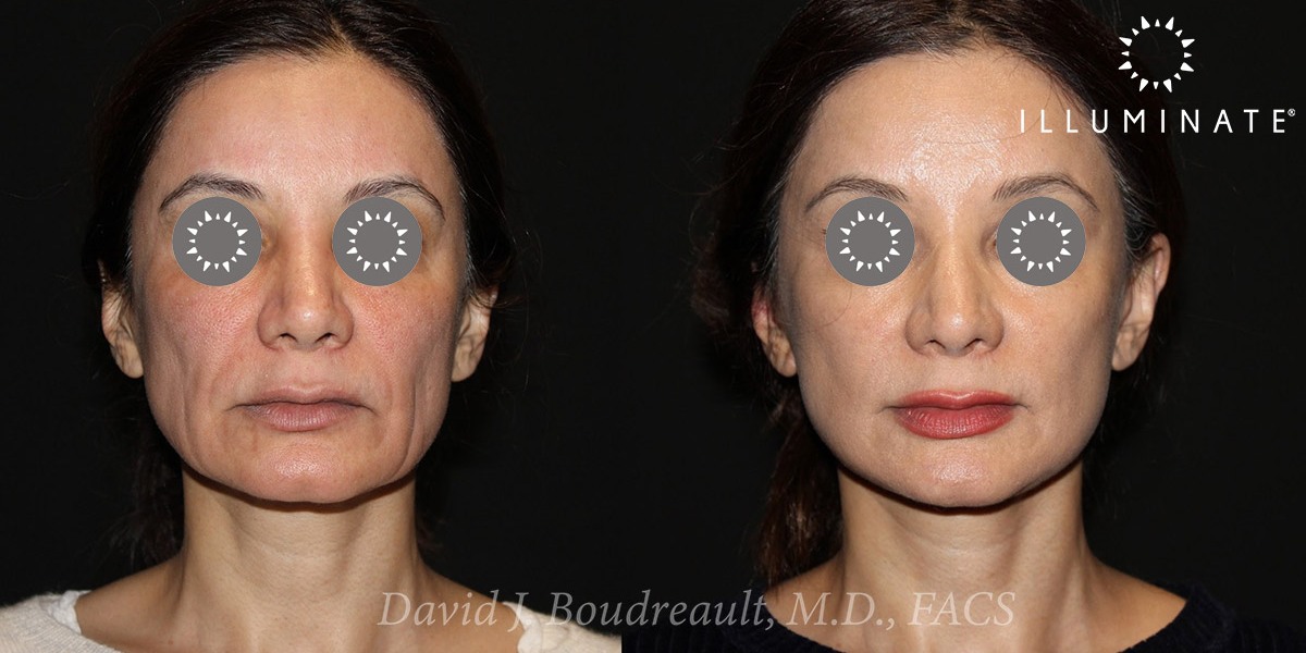Face & Neck Lift Before & After Image