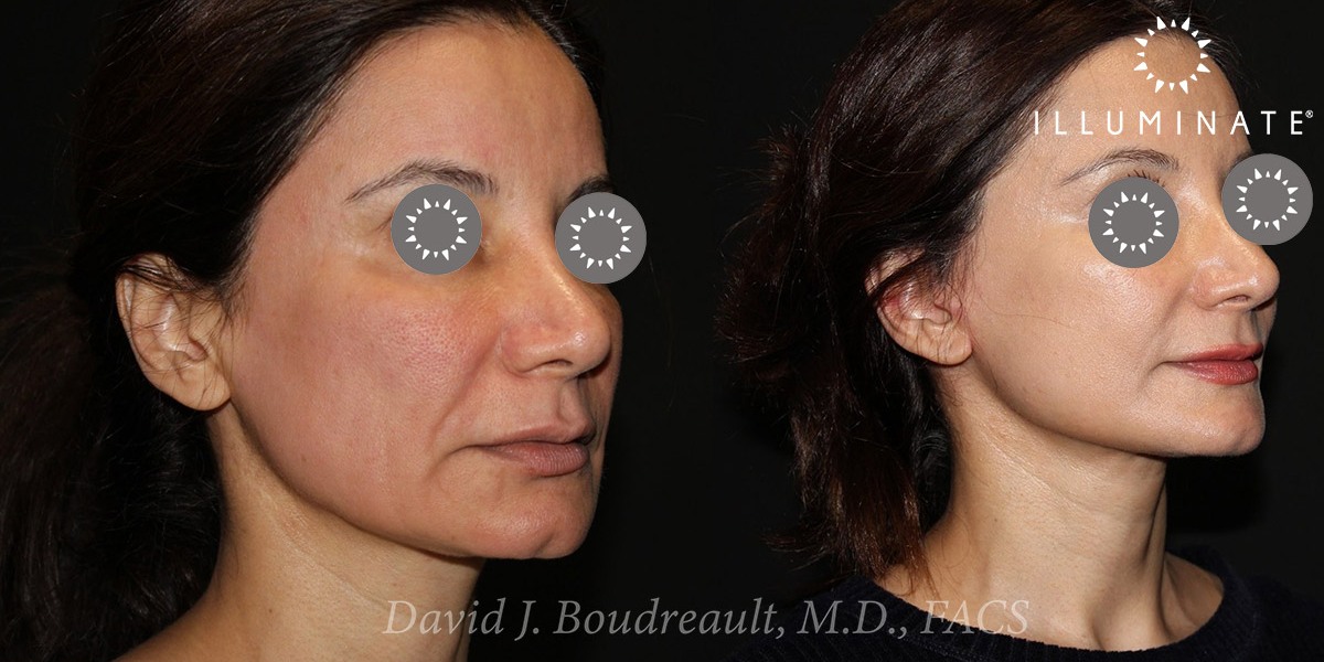 Face & Neck Lift Before & After Image