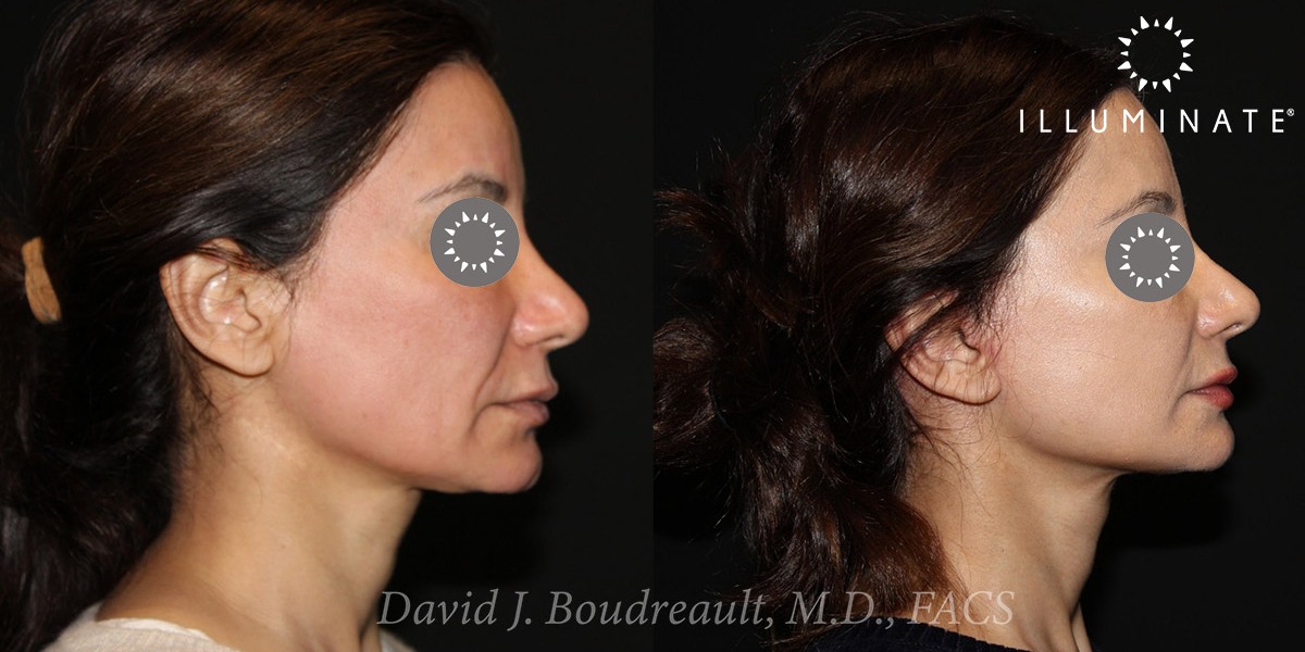 Face & Neck Lift Before & After Image