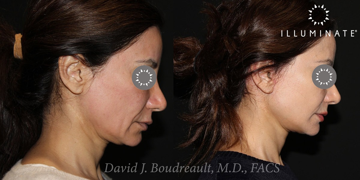 Face & Neck Lift Before & After Image