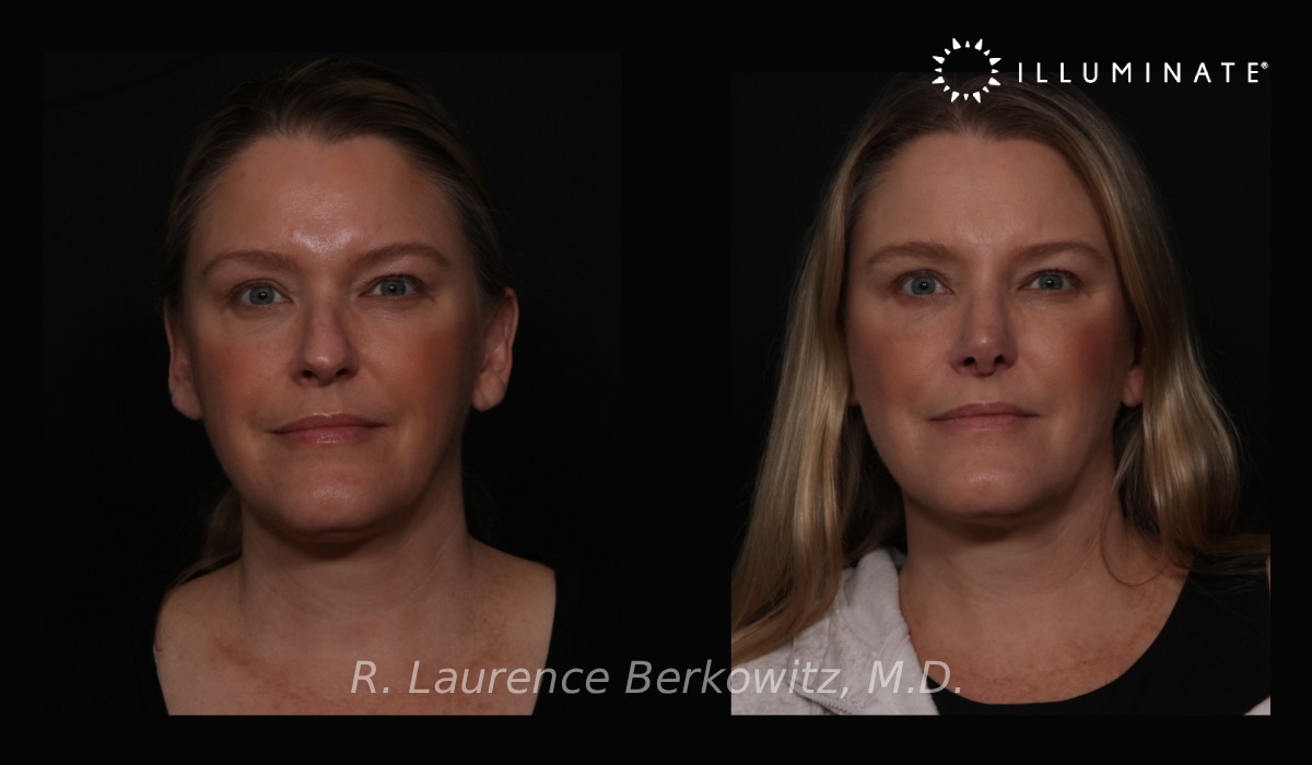 Revision Rhinoplasty Before & After Image