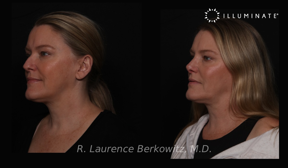 Revision Rhinoplasty Before & After Image