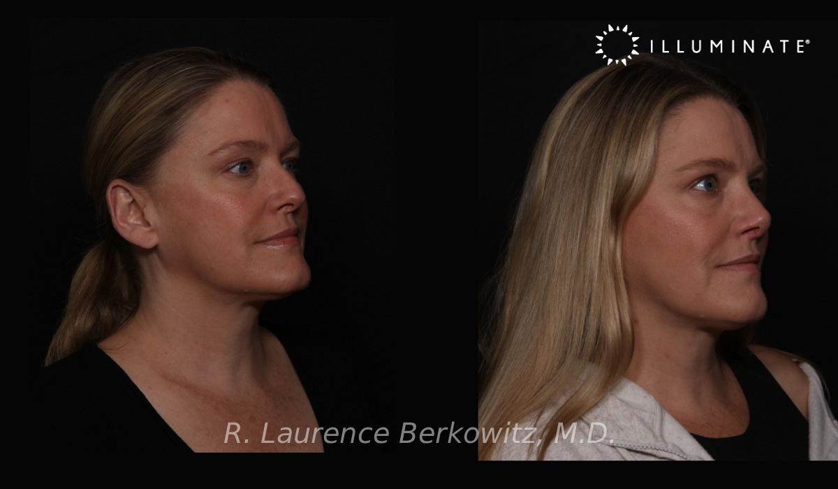 Revision Rhinoplasty Before & After Image
