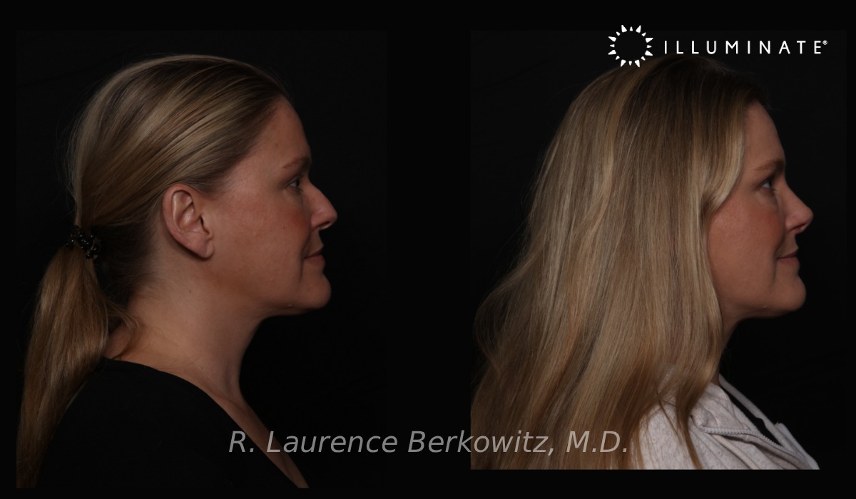 Revision Rhinoplasty Before & After Image