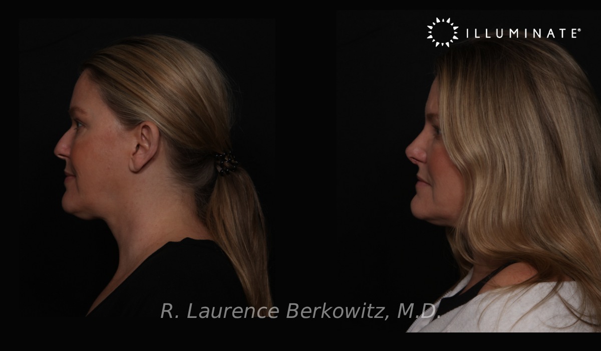 Revision Rhinoplasty Before & After Image