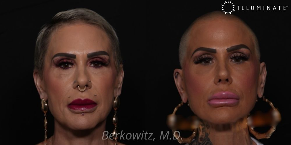 Rhinoplasty Before & After Image