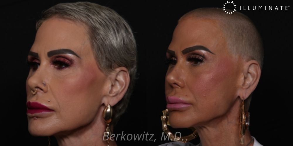 Rhinoplasty Before & After Image