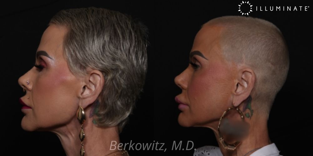 Rhinoplasty Before & After Image