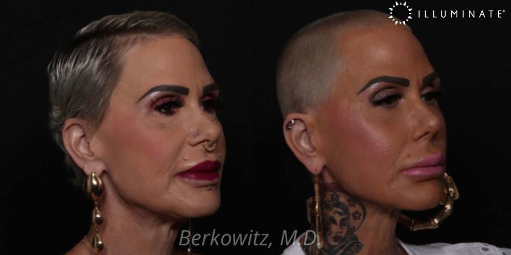 Rhinoplasty Before & After Image