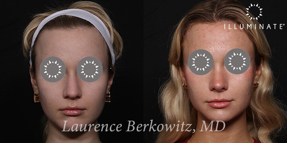 Rhinoplasty Before & After Image