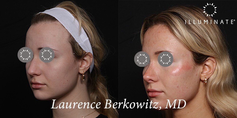 Rhinoplasty Before & After Image