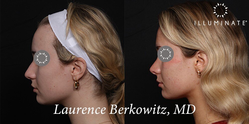 Rhinoplasty Before & After Image