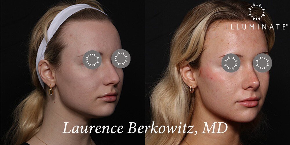 Rhinoplasty Before & After Image