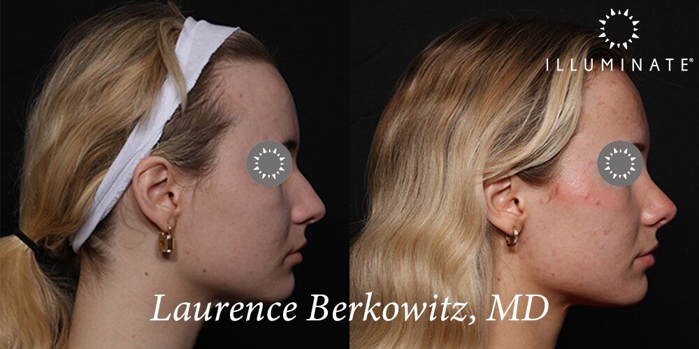 Rhinoplasty Before & After Image