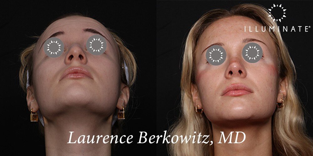 Rhinoplasty Before & After Image