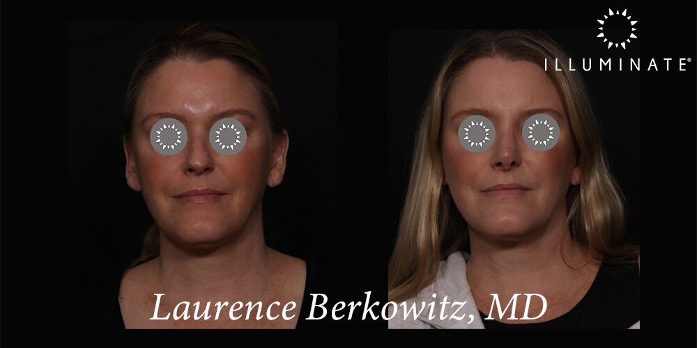 Rhinoplasty Before & After Image