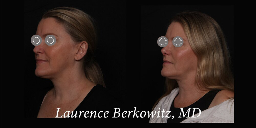 Rhinoplasty Before & After Image