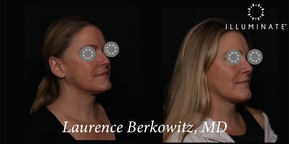 Rhinoplasty Before & After Image
